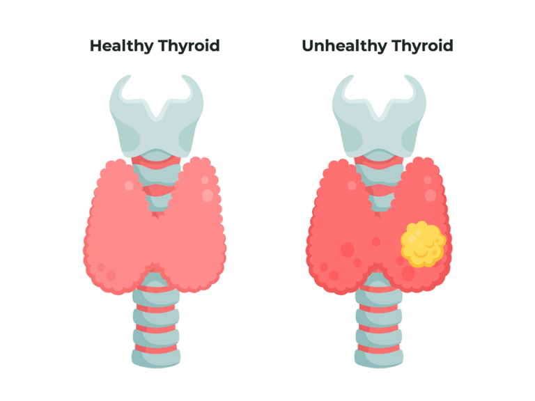 Thyroid and Neck Tumor Surgery - Tijuana Surgery Center